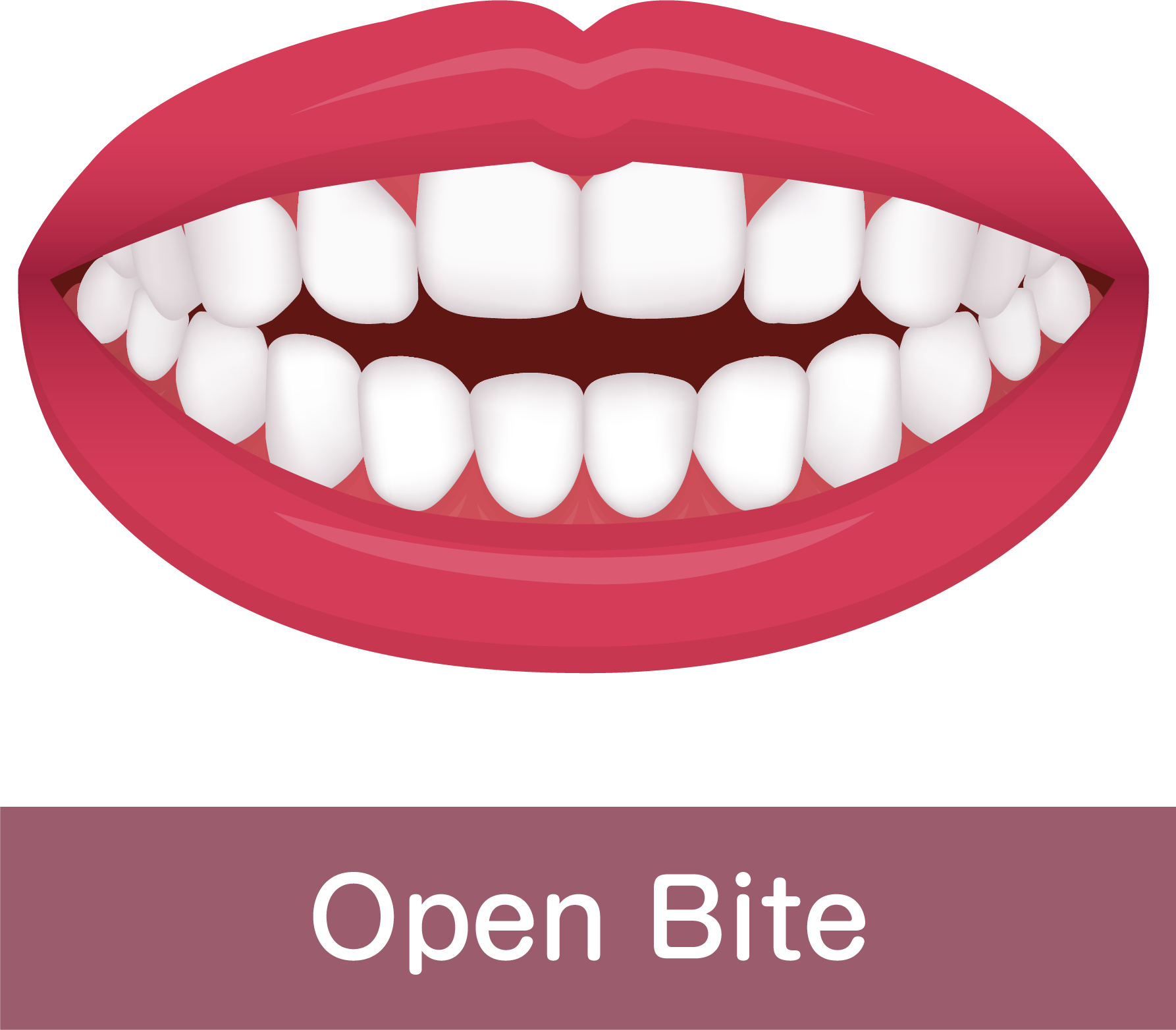 Open Bite Island Tower Dentistry