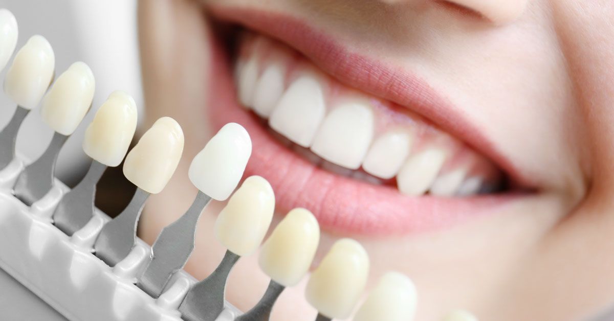 Choosing color of dental implants