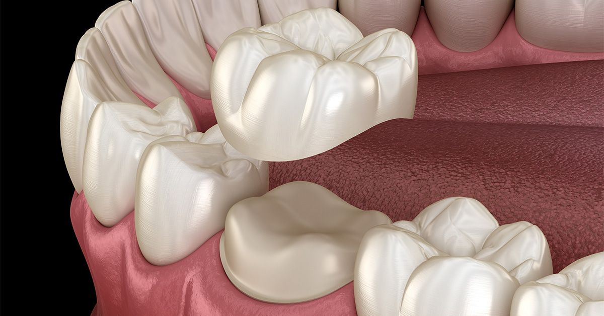 dental crown