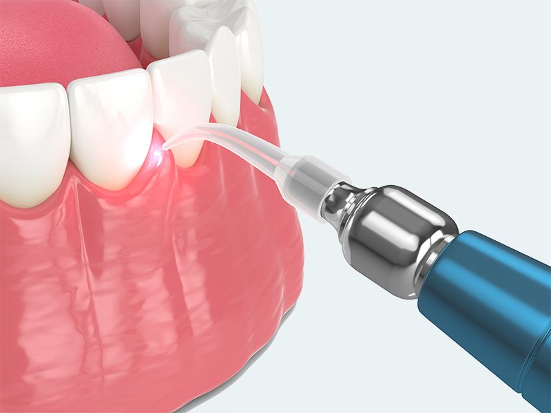 LANAP Laser Gum Disease Treatment Illustration