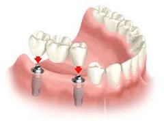 Model of Dental Implants in Marco Island FL replacing missing teeth