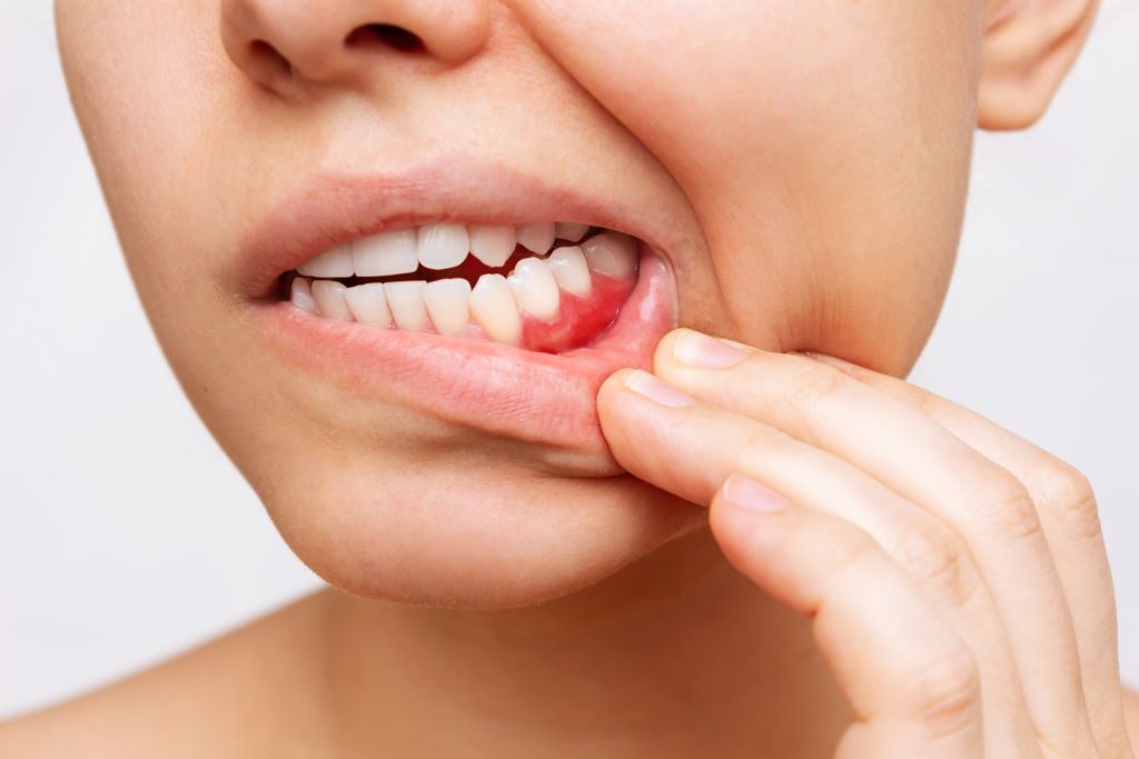 Periodontal Treatment and LANAP