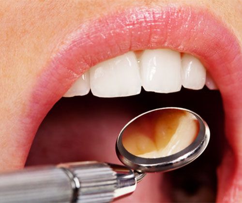 dental tool examining mouth 