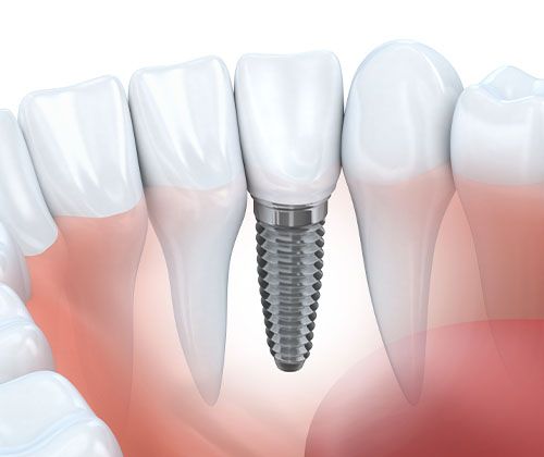 Dental Implants replacing missing tooth