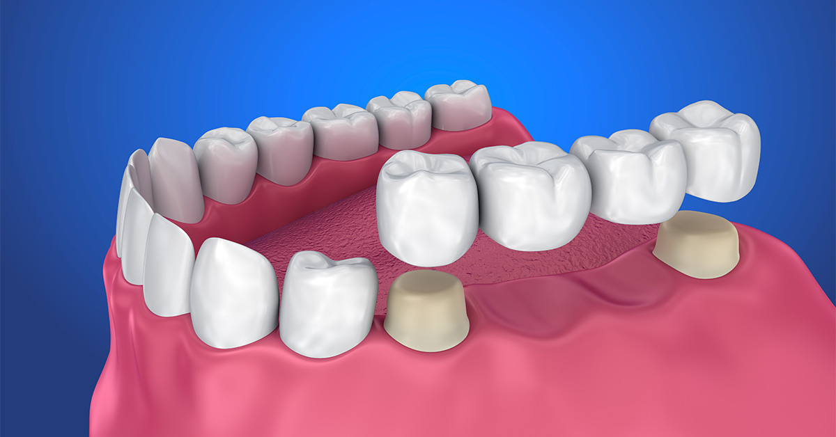 SW Florida Dentist Gives Dental Bridge Maintenance Tips