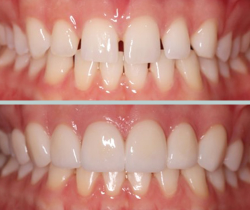 Before and after cosmetic dentistry