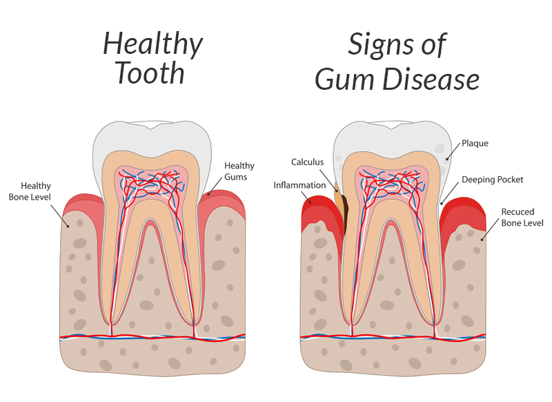 Gum Disease Diagram